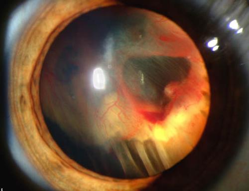 retinal detachment