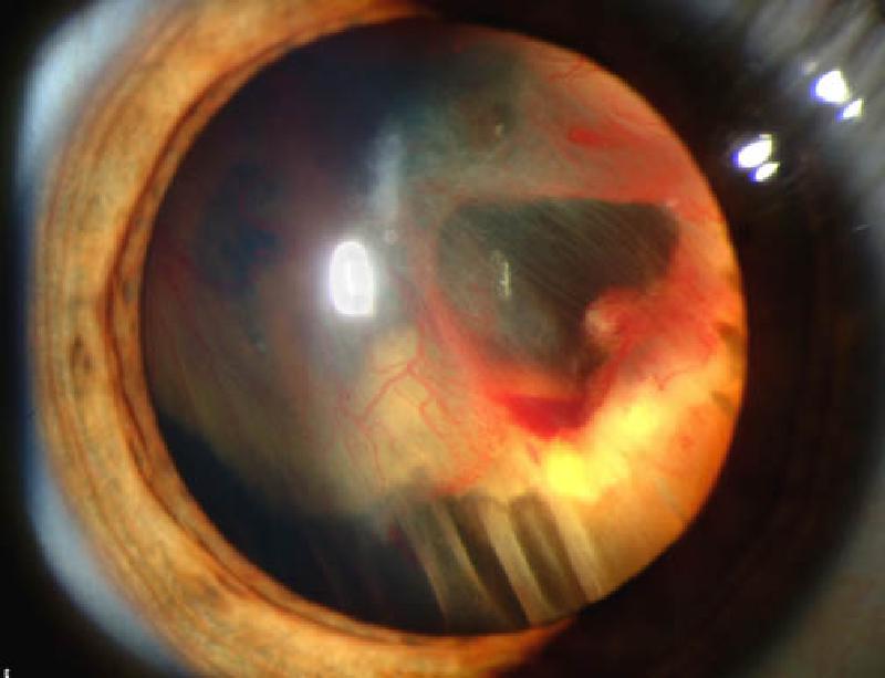 retinal detachment